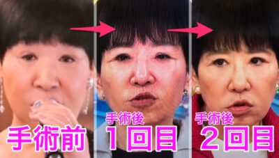 和田アキ子目の変化