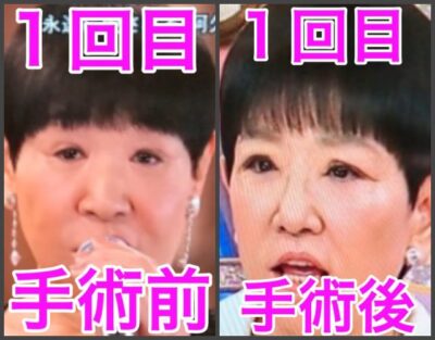 和田アキ子目術後比較