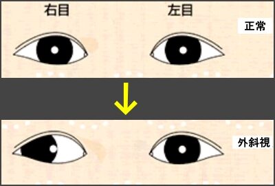 外斜視三浦大知