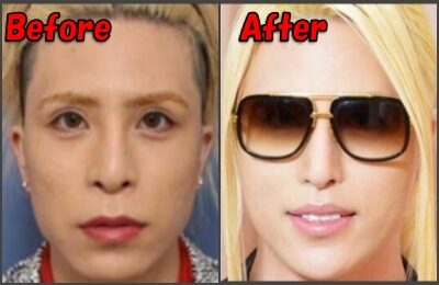 ローランド整形画像比較